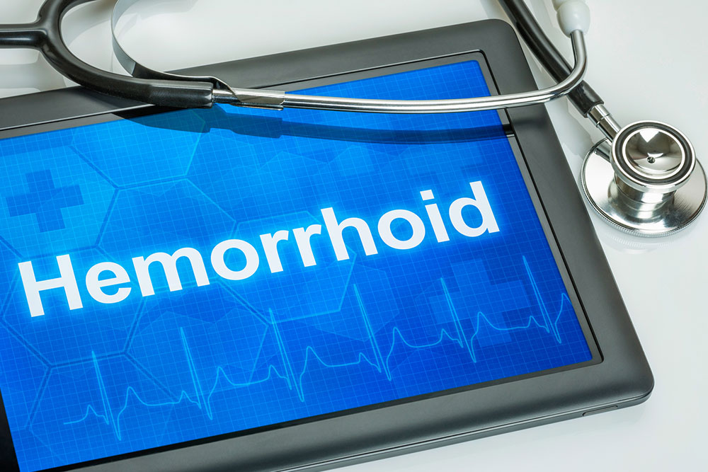 8 Ways to Treat Hemorrhoids