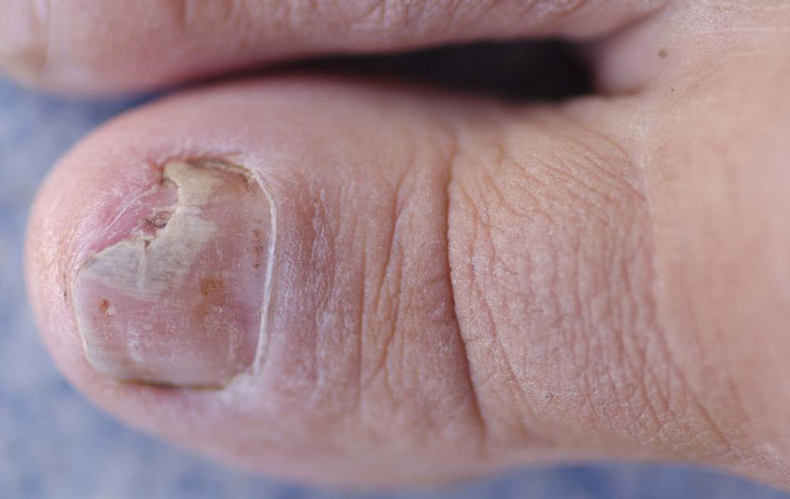 Effective Ways to Treat Toe Fungus