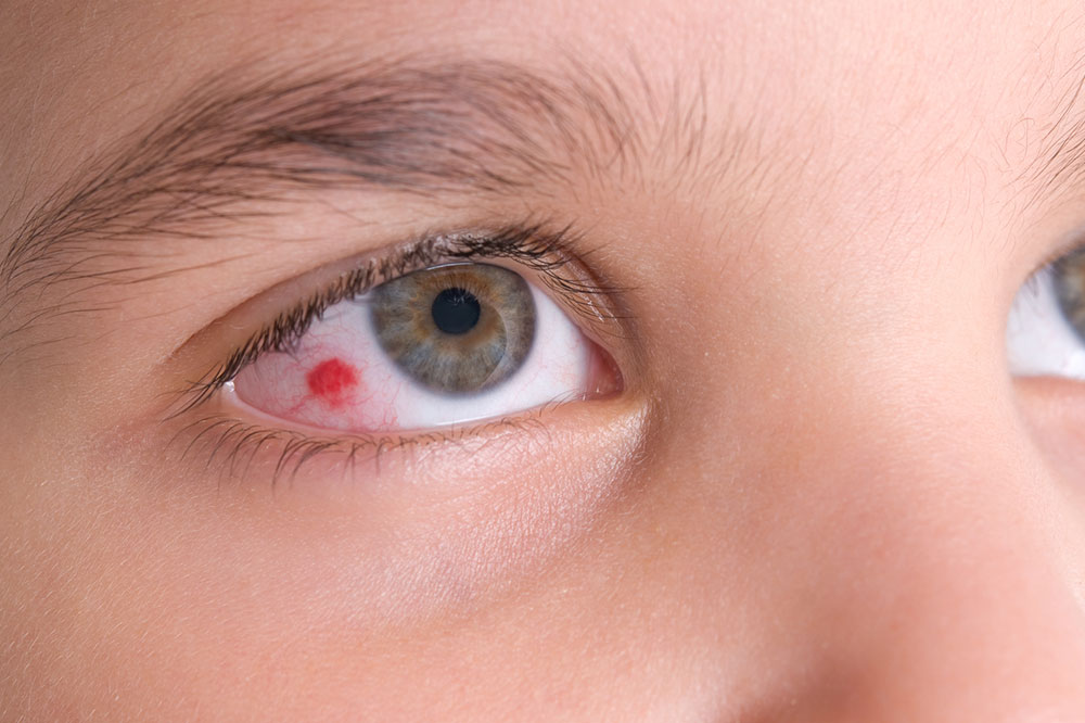 Eye infections &#8211; All you need to know