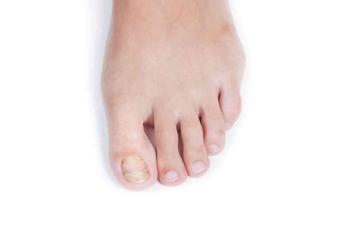 How to Treat Fungal Infections in the Toenails