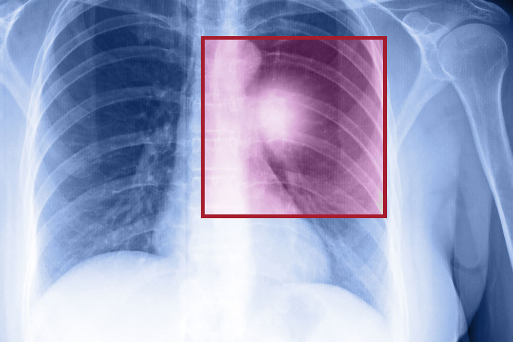 Symptoms and Treatment of Metastatic Lung Cancer