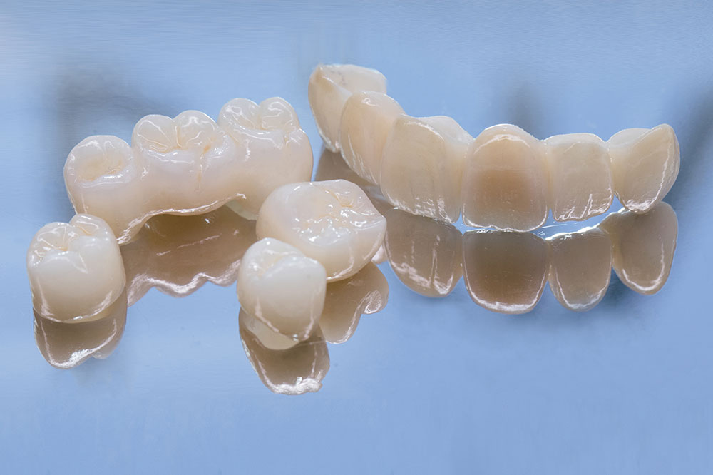 Things to Know Before Opting for Dental Bridges