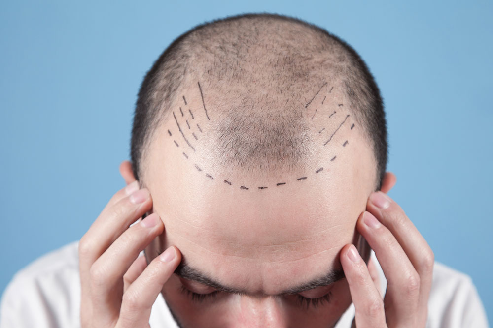 Hair Transplant &#8211; Techniques, Costs, and More